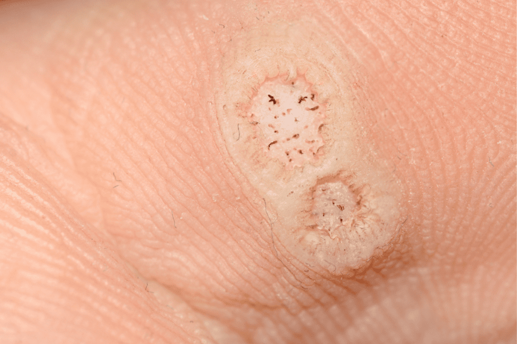 papiloma plantar pie alicante