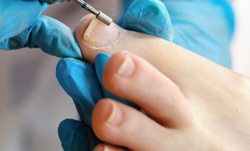 Reconstrucción ungueal: solución estética para uñas dañadas o deformadas